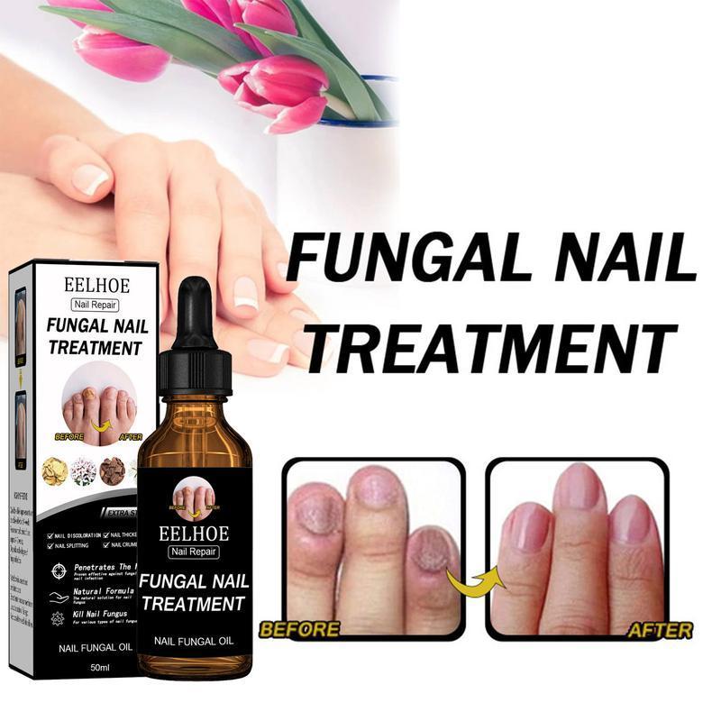 [Free shipping]EELHOE Nail Repair Solution Thickening BrightNails Removes Onychomycosis and Dead SkinRepairs Moisturizing Nail Art Nutritional CareSolution