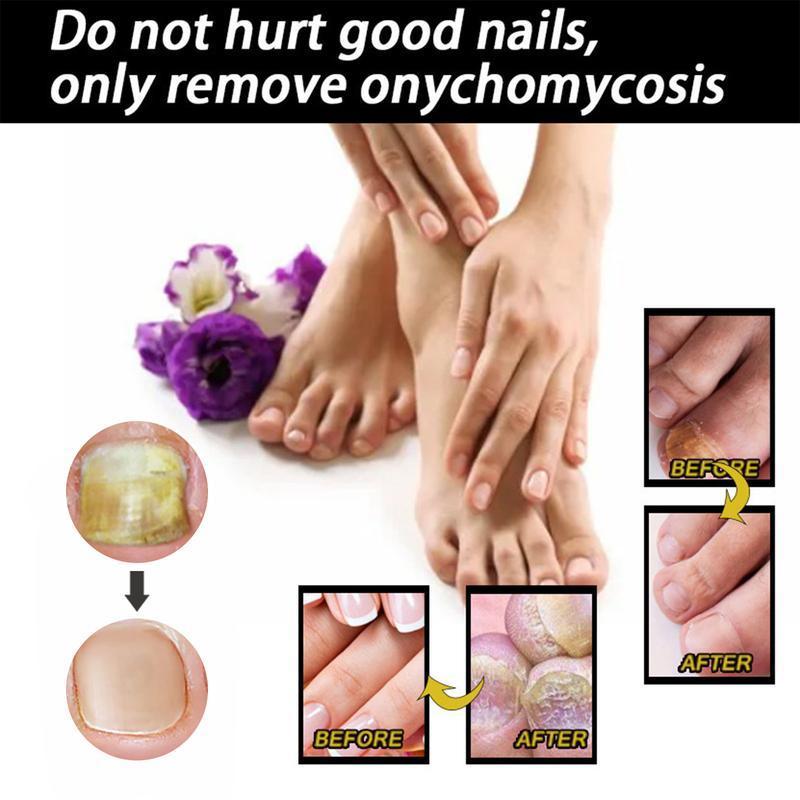 [Free shipping]EELHOE Nail Repair Solution Thickening BrightNails Removes Onychomycosis and Dead SkinRepairs Moisturizing Nail Art Nutritional CareSolution