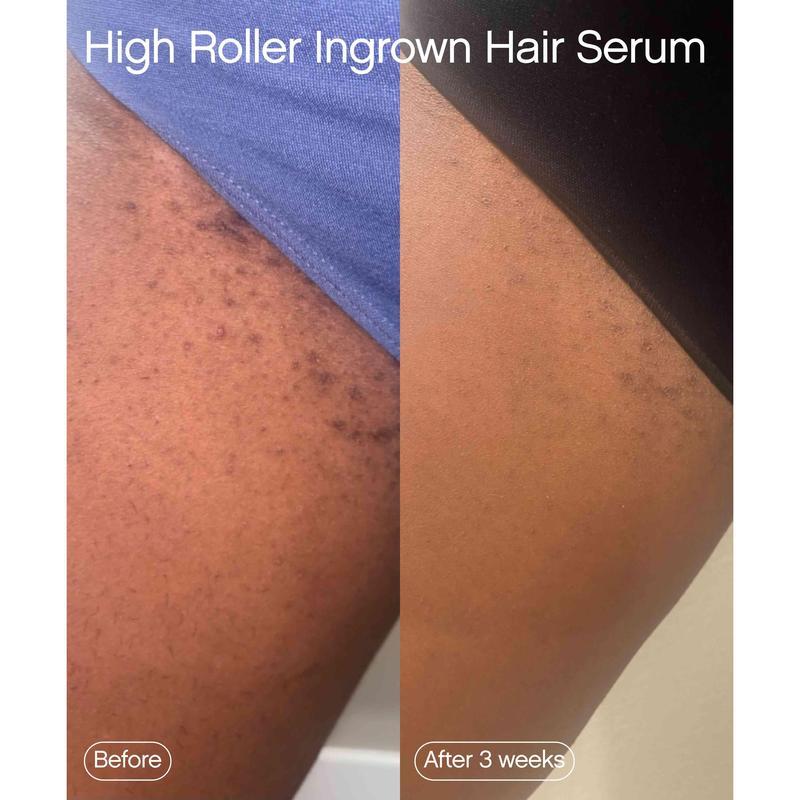 High Roller Ingrown Tonic - Serum for Eliminating Ingrown Hairs and Razor Bumps - Skincare Aftershave Foam Comfort Cleansing