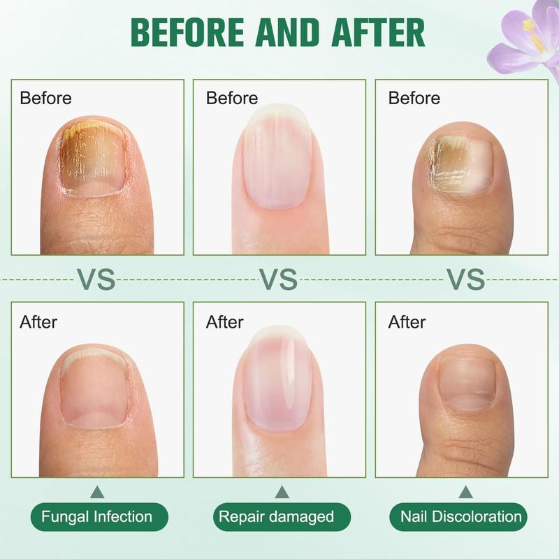 [Buy one get one free]Plant Drops Nail Fungus for Nails Moisturizer Oregano Tea Tree, Support Comfort Moisturizer for Toenail Nourishing Nail Polish