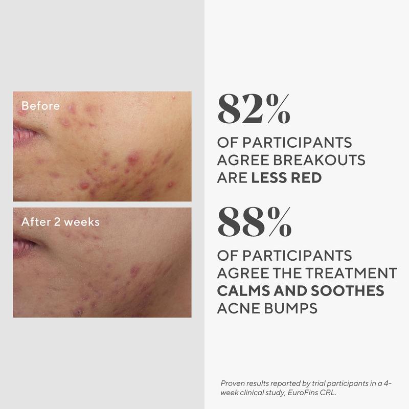 Deep Relief Acne Treatment with Salicylic Acid