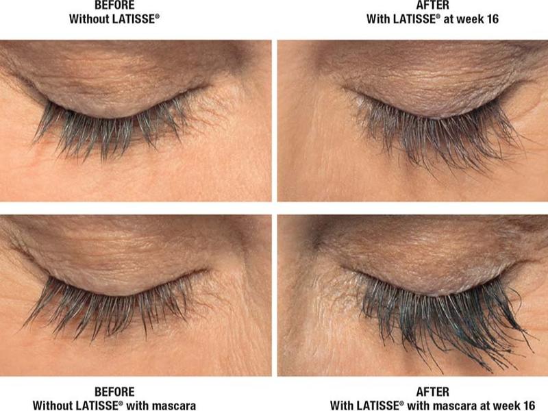 Latisse (Eyelash Growth Serum) Pack Kit for Fuller, Darker, Longer Fuller Eye Lashes 140 Applications