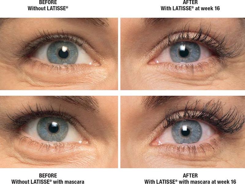 Latisse (Eyelash Growth Serum) Pack Kit for Fuller, Darker, Longer Fuller Eye Lashes 140 Applications